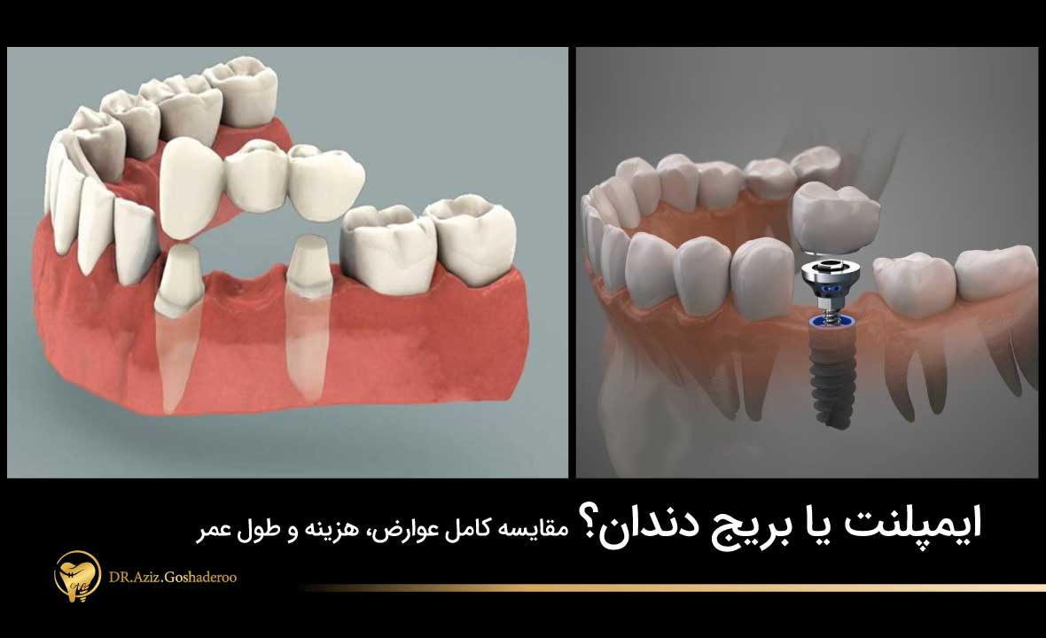ایمپلنت یا بریج دندان؟ مقایسه کامل عوارض، هزینه و طول عمر (کدام بهتر است؟)